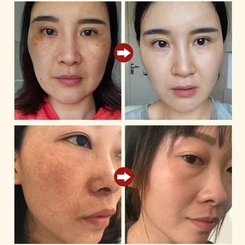 เซรั่มลดเลือนจุดด่างดำ ฝ้า กระ - Licorice Root Extract บทวิจารณ์และราคา