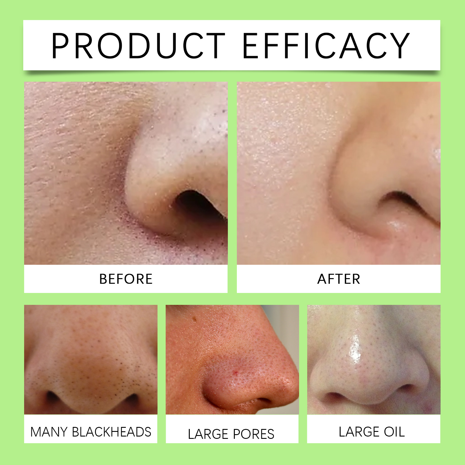 แผ่นแปะจมูกถ่านไม้ไผ่สำหรับสิว - Skincare Collagen บทวิจารณ์และราคา